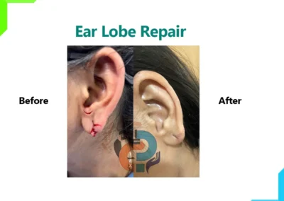 Ear lobe Repair