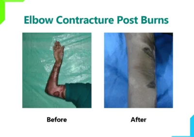 Elbow Contracture Post Burns