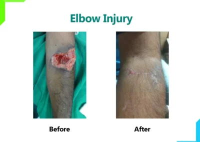 Elbow Injury