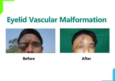 Eyelid Vascular Malformation