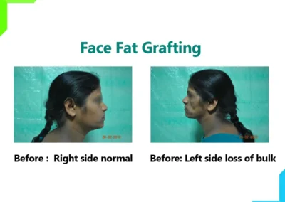 Face Fat Grafting