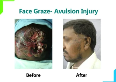 Face Graze - Avulsion Injury