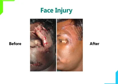 Complex face laceration