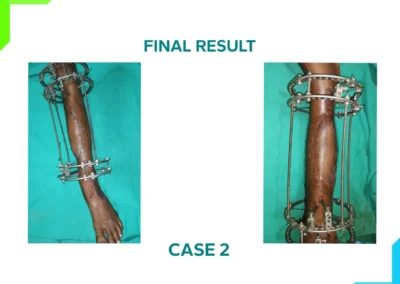 Limb Reconstruction Case 2