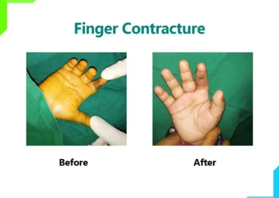 Index Finger Contracture