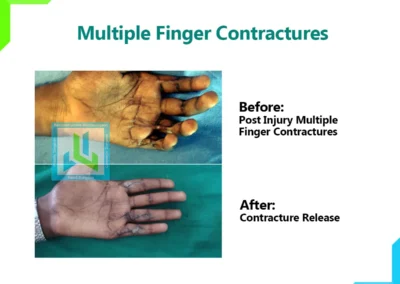 Multiple Finger Contractures