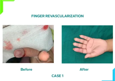 Finger Revascularization