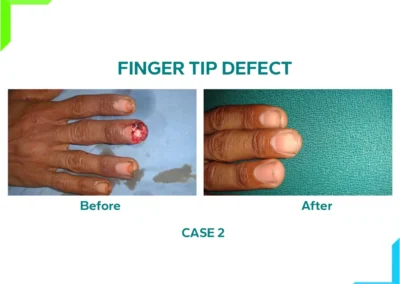 Finger Tip Defect