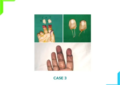 Finger tips amputation - Revascularization