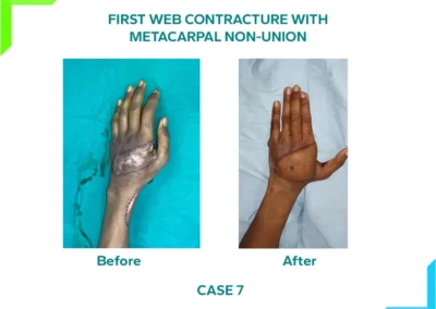 First Web Contracture