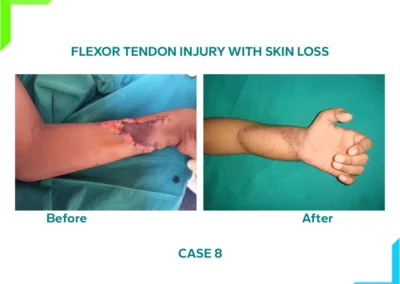 Flexor Tendon Injury with skin loss