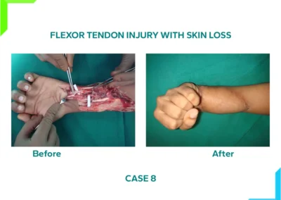 Flexor Tendon Injury with skin loss