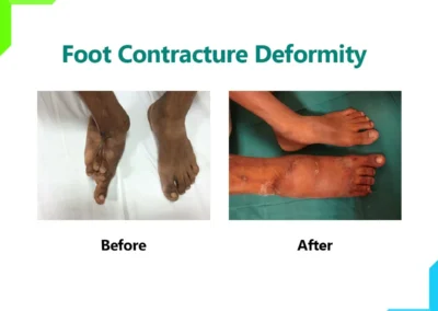 Foot Contracture Deformity