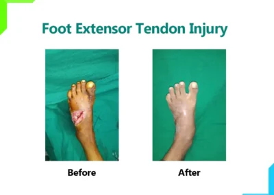 Foot extensor tendon injury
