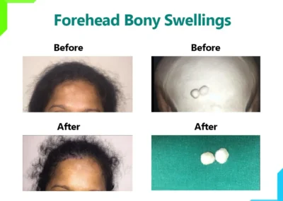 Forehead Bony Swellings