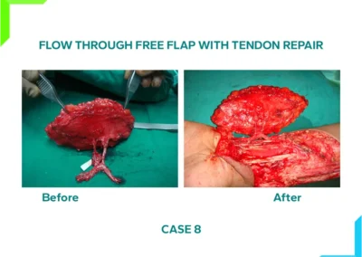 Free Flap With Tendon Repaired