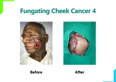 Fungating Cheek Cancer