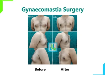 Gynaecomastia Surgery