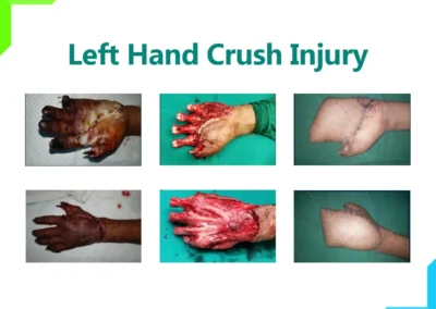 Left Hand Crush Injury