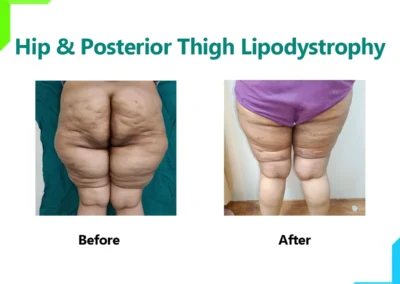 Hip and Posterior Thigh Lipodystrophy