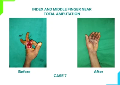 Index and middle Finger Near Total Amputation