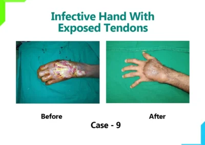 Infective Hand With Exposed Tendons