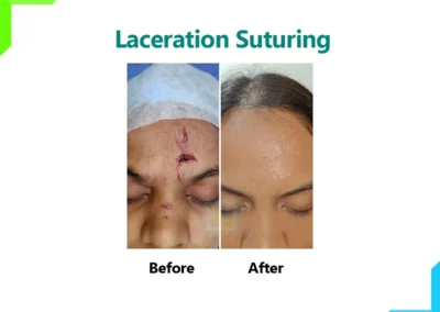 Laceration Suturing