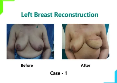 Left Breast Reconstruction Case-1