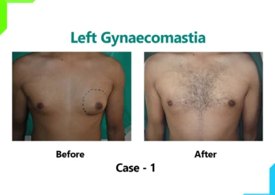 Left Gynaecomastia Case-1