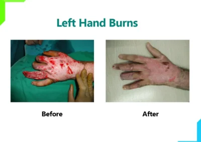 Left Hand Burns