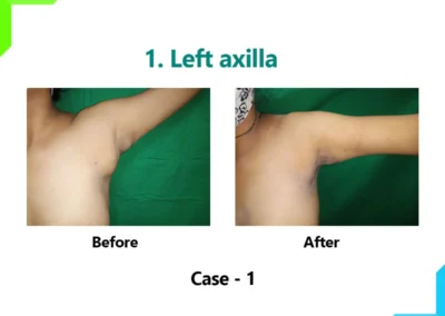 Left Axilla Case-1