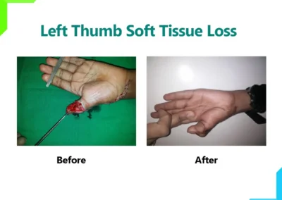 Left thumb soft tissue loss