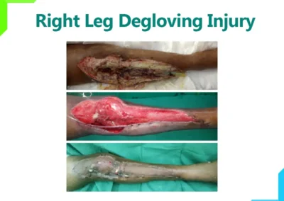 Leg Degloving Injury