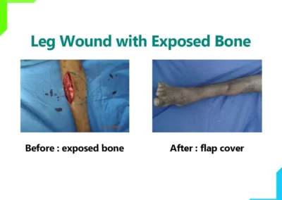 Leg Wound with Exposed Bone