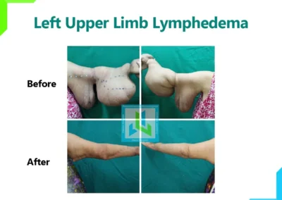 Limb Lymphedema