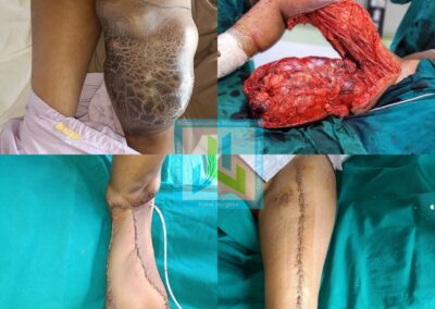 Limb Reconstruction - Free flap for sarcoma excision and limb salvage