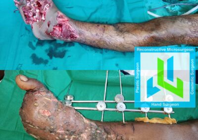 Limb Reconstruction crush injury foot - Foot Salvage