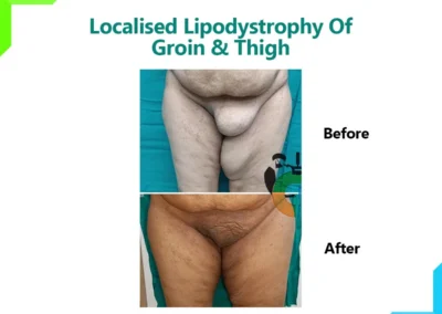 Localized Lipodystrophy of Groin and Thigh