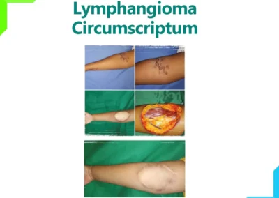 Lymphangioma Circumscriptum
