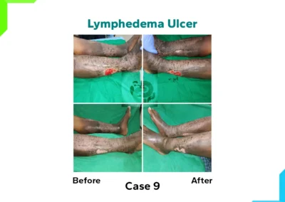 Lymphedema Ulcer