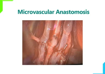Microvascular Anastomosis