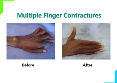 Middle Finger Contractures