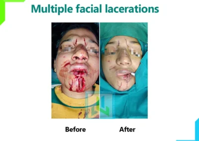 Multiple Facial Lecerations