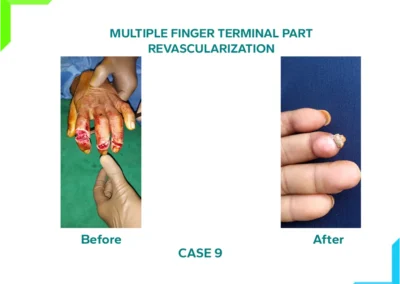 Multiple finger tip amputation - Revascularization