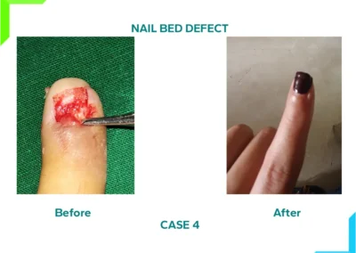 Nail Bed Defect - Grafting