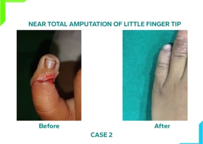Little finger near total amputation