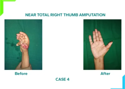 Near Total Right Thumb Amputation