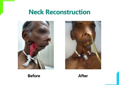 Neck Reconstruction