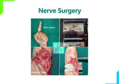 Nerve surgery