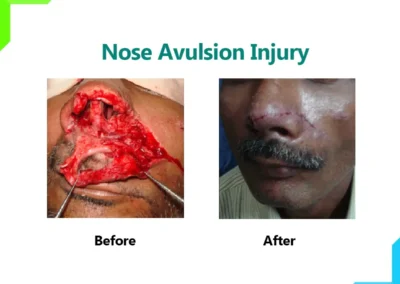 Nose Avulsion Injury